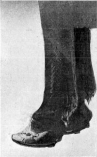 Fig. 33&mdash;The hoof in chronic laminitis. Note the
concavity. This animal was serviceable for any work that could be
performed at a walk.