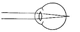 FIG. 79.&mdash;The farsighted eye.