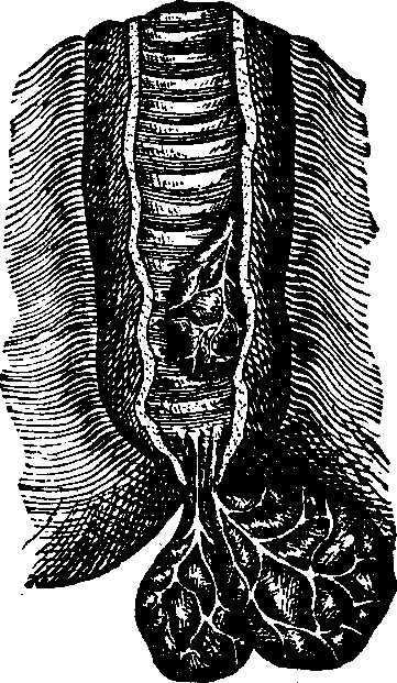Illustration:
Fig. 2. Piles: internal and protruding.