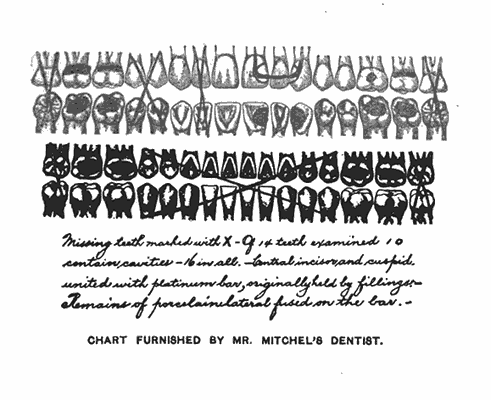 Missing teeth marked with X&mdash;Of 14 teeth examined 10
contain cavities&mdash;16 in all.&mdash;Central incisor and cuspid
united with platinum bar, originally held by fillings.&mdash;
Remains of porcelain material fused on the bar.

CHART FURNISHED BY MR. MITCHEL'S DENTIST.