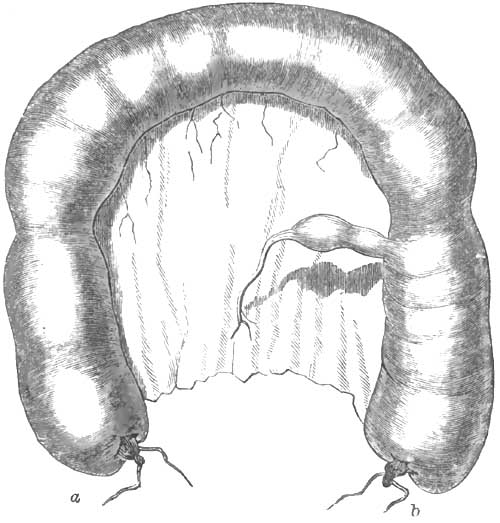 Natural relations of the
		diverticulum to the intestine