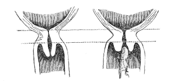 Neck of
the Womb