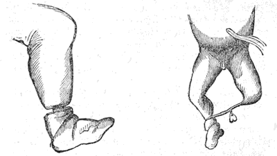 Limbs
cut off by the Cord