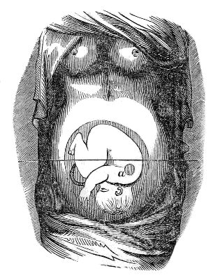 Fœtus
in the most usual position